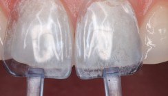 Präfabrizierte Kompositveneers – ein Fallbericht