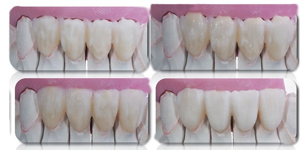 Minimalinvasive Veneers: ästhetisch-biologische Aspekte