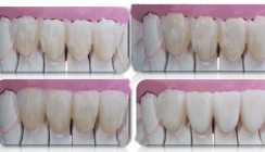 Minimalinvasive Veneers: ästhetisch-biologische Aspekte