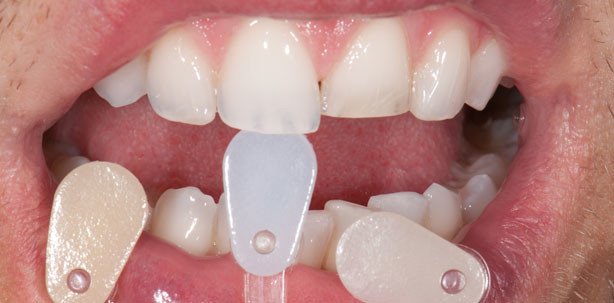 Königsdisziplin Einzelzahnveneer