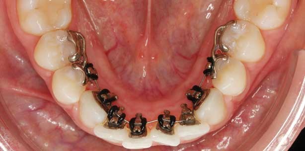 Neue Verankerungsoption