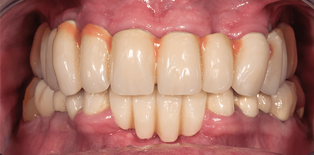 Implantatgetragene Verbundbrücke als Therapieoption