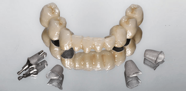 Festsitzender Zahnersatz: Lebensqualität bei alternden Patienten