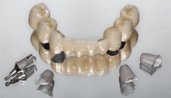 Festsitzender Zahnersatz: Lebensqualität bei alternden Patienten