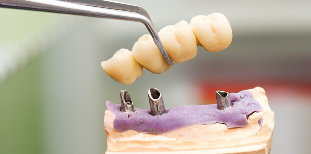 Verschrauben oder Zementieren –  Das ist hier die Frage!