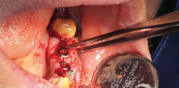 Therapievorschlag: Implantologie, Augmentation und Vestibulumplastik