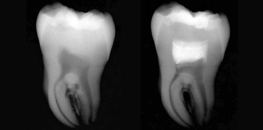 Möglichkeiten zur Vitalerhaltung der Pulpa mit MTA