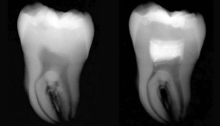 Möglichkeiten zur Vitalerhaltung der Pulpa mit MTA