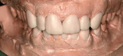 Kompositkunststoff für die Herstellung eines Modells