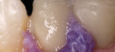 Direkte adhäsive Stiftbefestigung und Stumpfaufbau in einer Sitzung