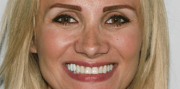 Versorgung einer Oberkieferfront mit Veneers und Vollkeramikkronen