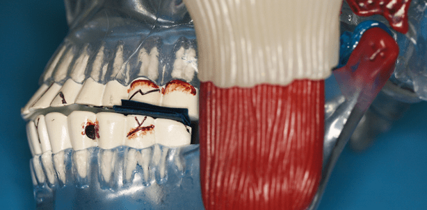 Vollkeramik: Risikomanagement für das Sensibelchen