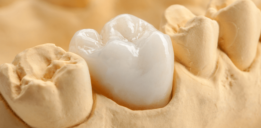 Vollkeramikkronen auch für Menschen, die pressen und knirschen?