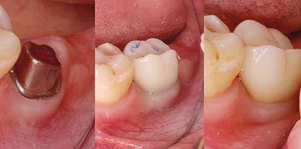 Vollkeramische Implantatversorgung leicht gemacht