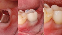Vollkeramische Implantatversorgung leicht gemacht