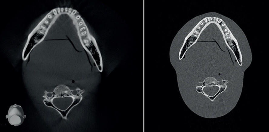 Digitale Volumentomografie in der Implantologie