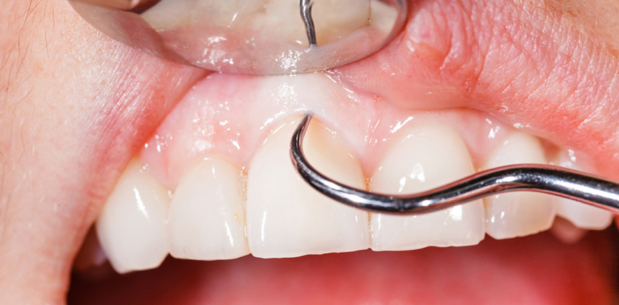 Illegales Bleaching: Teenager verliert Zähne