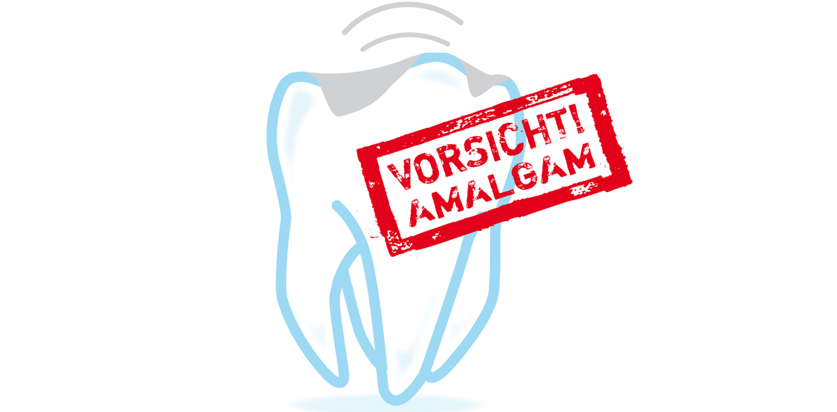 Vorerst kein Phase-out von Amalgam