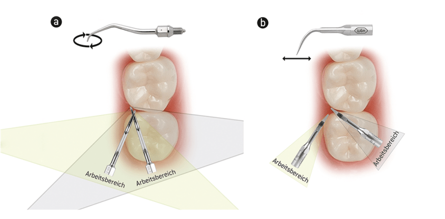 Effektive Furkationstherapie mit universeller Luftscalerspitze