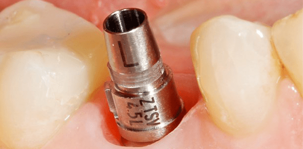 Klinische Aspekte des digitalen implantologischen Workflows