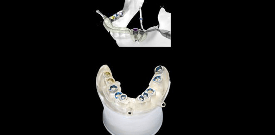 Webinar thematisiert digitalen Workflow in der Implantologie