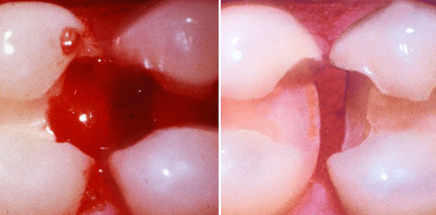 DT Study Club: Webinar zu Tissue Management