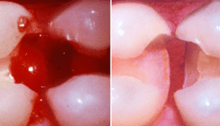DT Study Club: Webinar zu Tissue Management