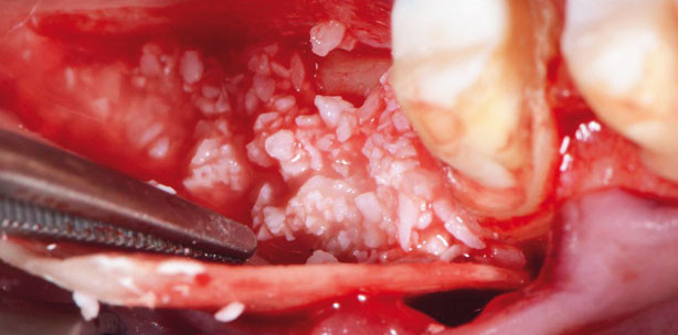 Implantologe beleuchtet knöcherne Augmentation mit GBR-Technik