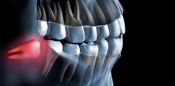 Weisheitszahn-OP – die Zeit danach