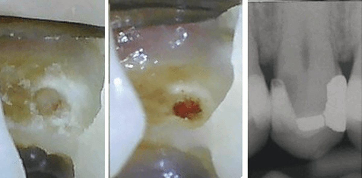 Bessere Überkappungen in tiefen Läsionen