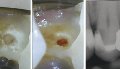 Bessere Überkappungen in tiefen Läsionen