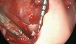 Minimalinvasive Entfernung von verlagerten unteren Weisheitszähnen
