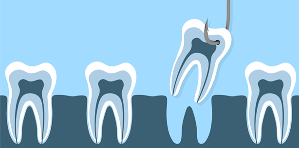 Abwarten oder handeln? Weisheitszahn-OP gut abwägen