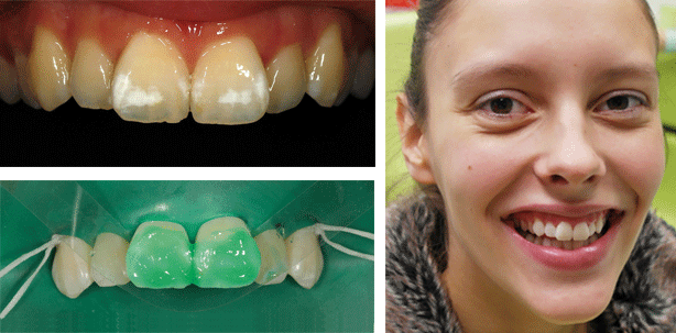 Fluoroseinfiltration: Kasuistik bei einer jungen Patientin