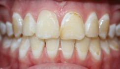 White-Spot-Läsionen während Multibracketbehandlungen