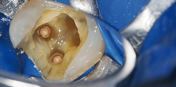 Geringe Instrumentenzahl auch für ­komplexe Kanalsysteme