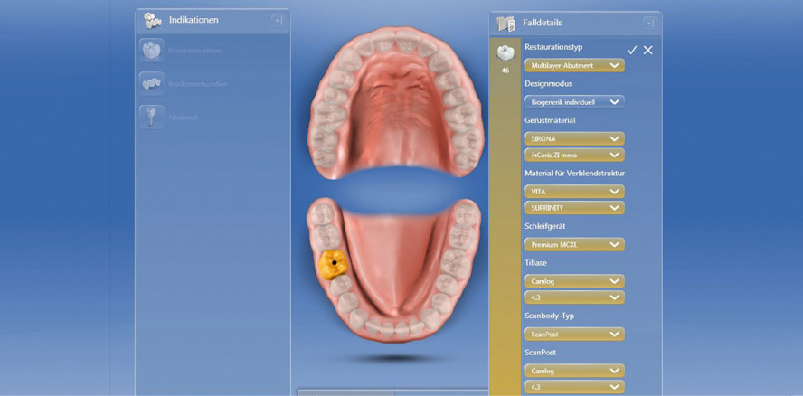 Digitaler Workflow nach Implantatfreilegung