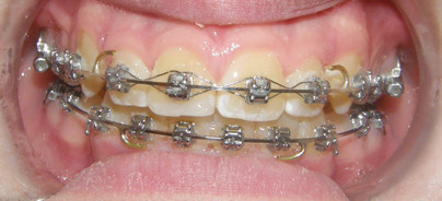 Interaktives selbstligierendes Hybridsystem