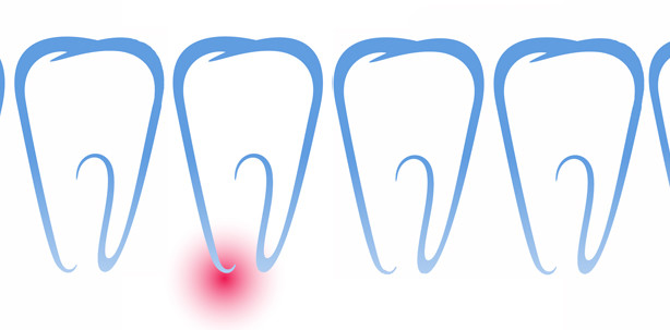 Vertikale Wurzelfrakturen nach endodontischen Therapien