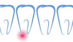 Vertikale Wurzelfrakturen nach endodontischen Therapien