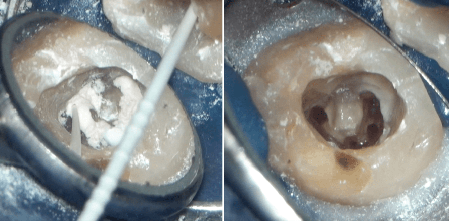 Wurzelkanalspülung neu gedacht