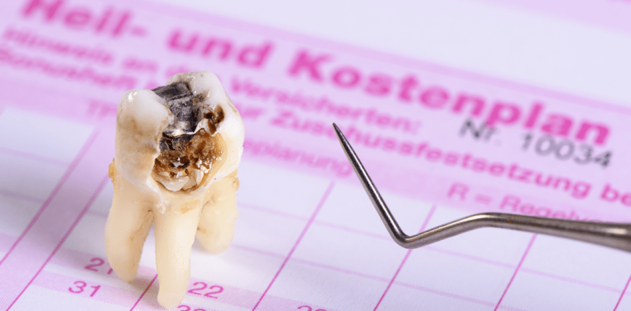 Wirtschaft und Stress Schuld an schlechten Wurzelfüllungen?