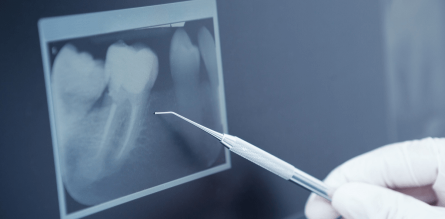 Optimale Wurzelfüllung?