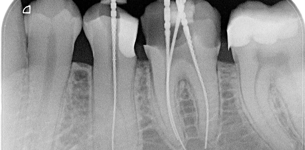 Zähne mit besonderen Wurzelkanalanatomien – Teil 1: Prämolaren