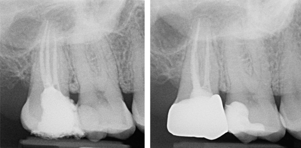 Reziproke Wurzelkanalaufbereitung in der Allgemeinpraxis