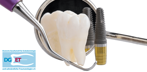 Wurzelkanalbehandlung oder doch besser ein Implantat?