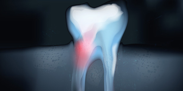 Wurzelkaries auf dem Vormarsch