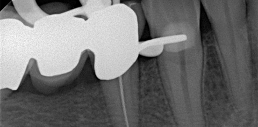 Überpresste Wurzelkanalfüllpasten = Sealer-Puff?