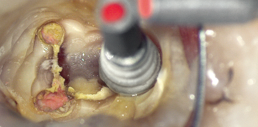 Wurzelstifte für extreme Anforderungen