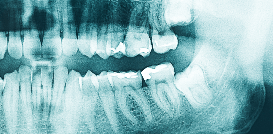 Verdacht auf HIV stellt sich als entzündeter Weisheitszahn heraus